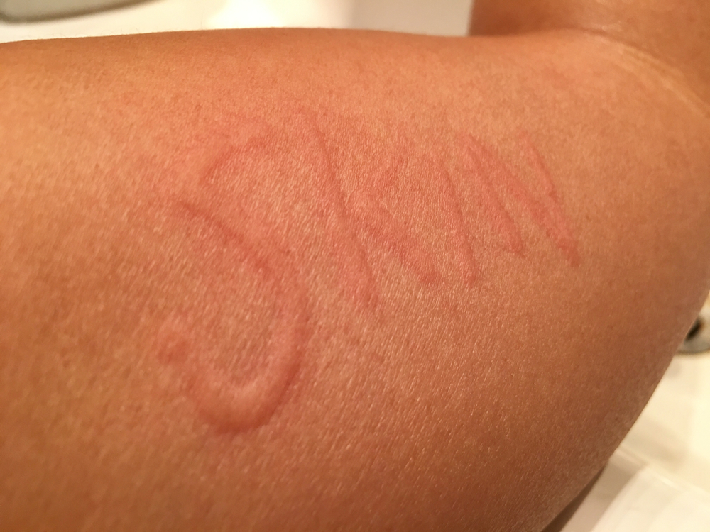 Prevent Dermatographia From Itching Too Much