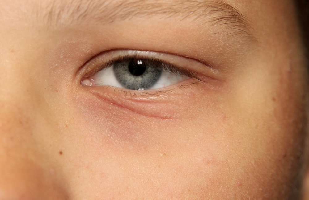 Eyelid Dermatitis: What to Do When Itch Strikes