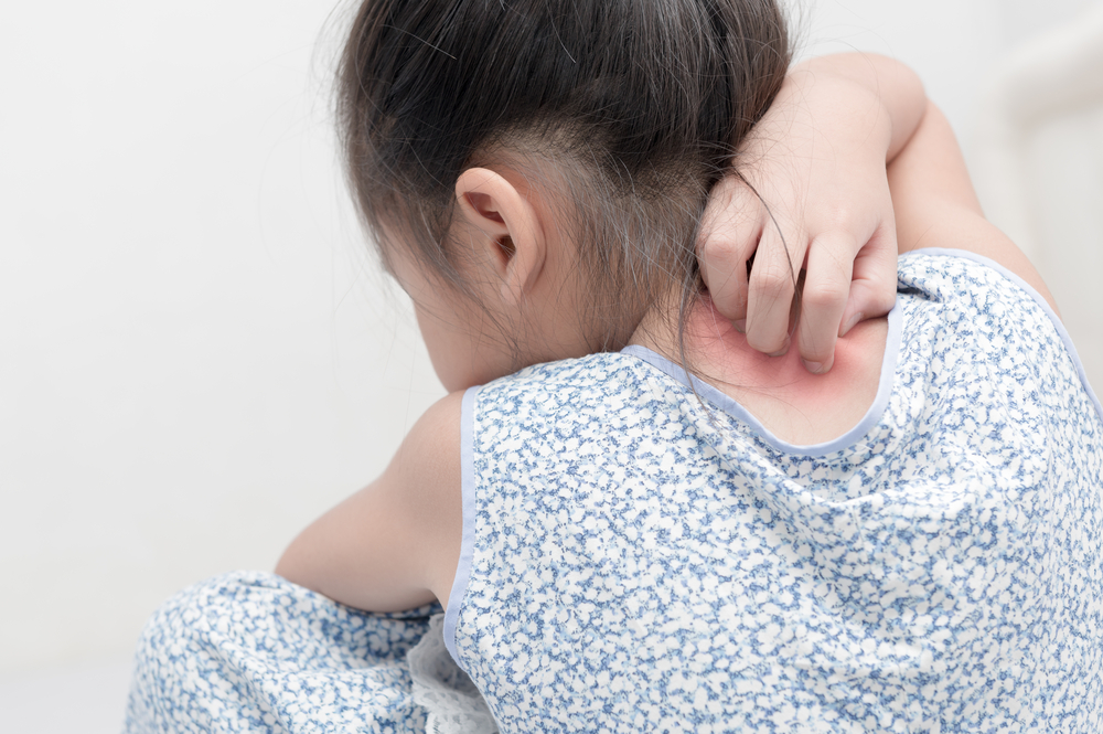 Eczema and Bullying: How to Address It