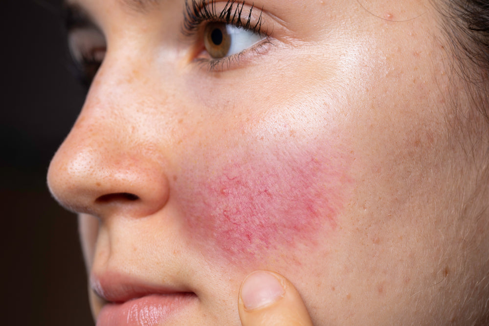 LET’S FACE IT: Rosacea and face masks 