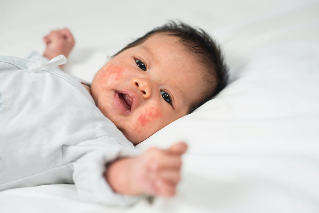 6 Common Skin Irritations in Infants You Should Be Aware Of