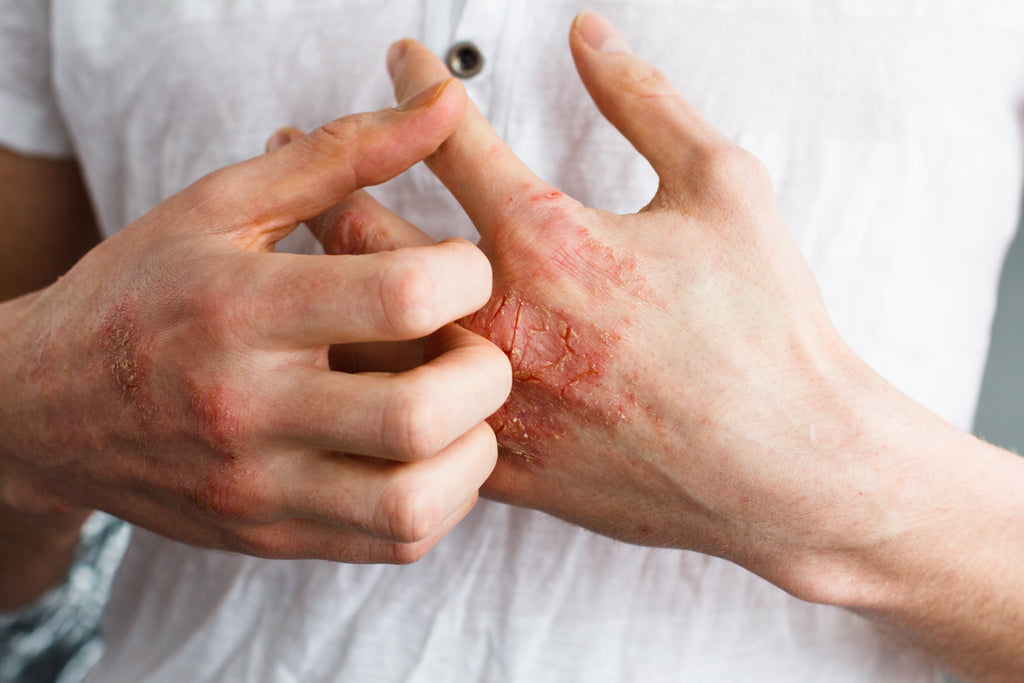 Top 10 Myths about Atopic Eczema