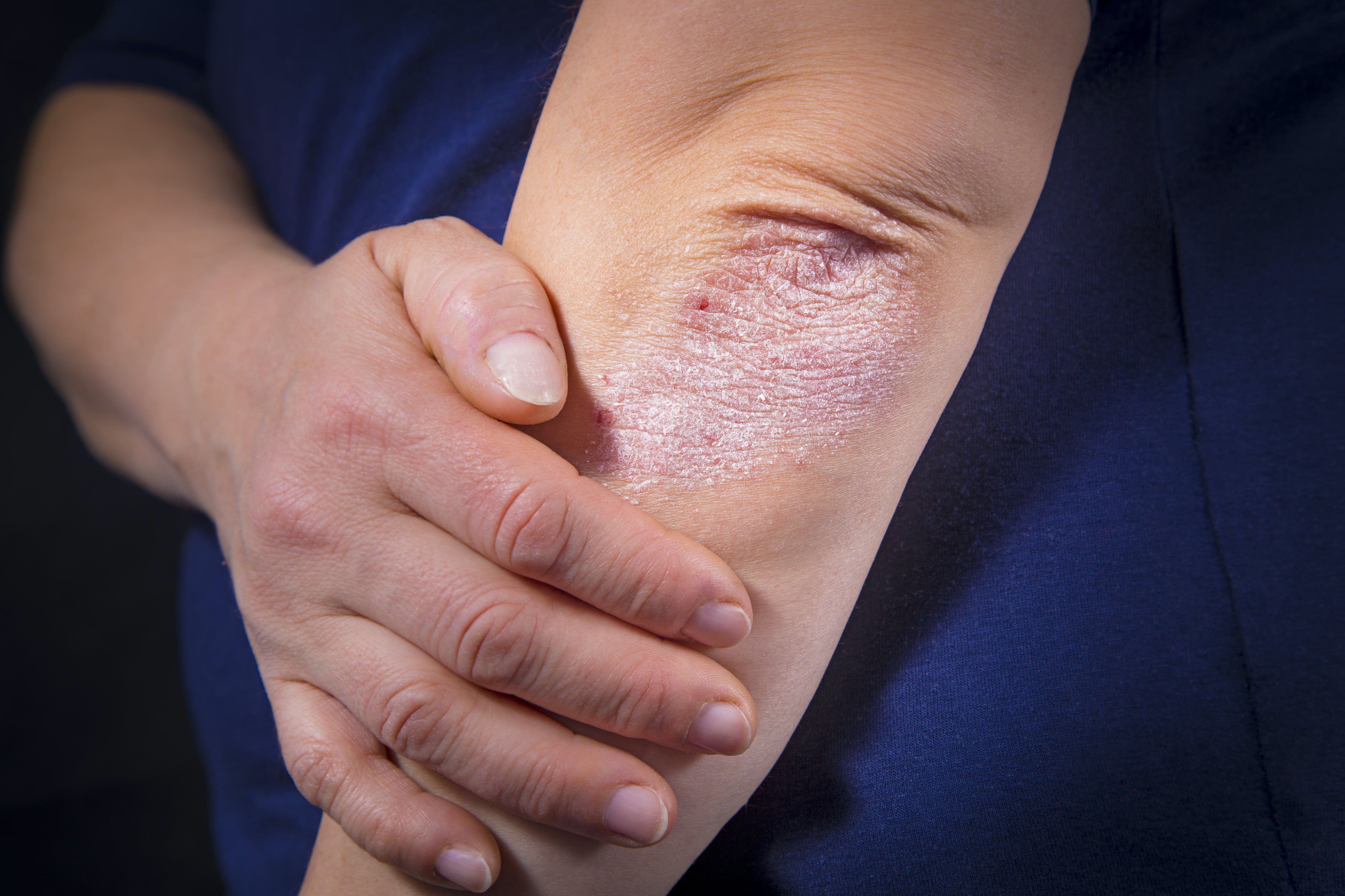 Debunking misconceptions about psoriasis