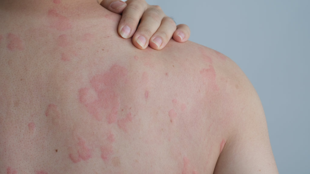 Relieve the Itch: Here’s Everything You Need to Know About Postpartum Hives